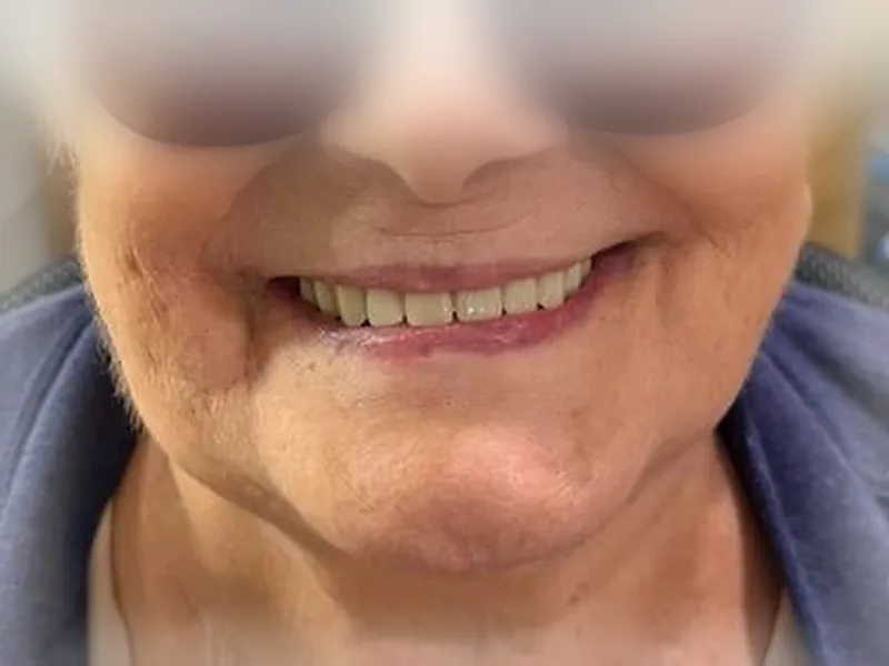 Patiente âgée souriante avec des prothèses complètes