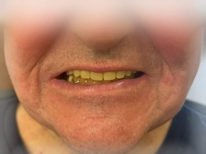 Patient âgé souriant avec une prothèse partielle